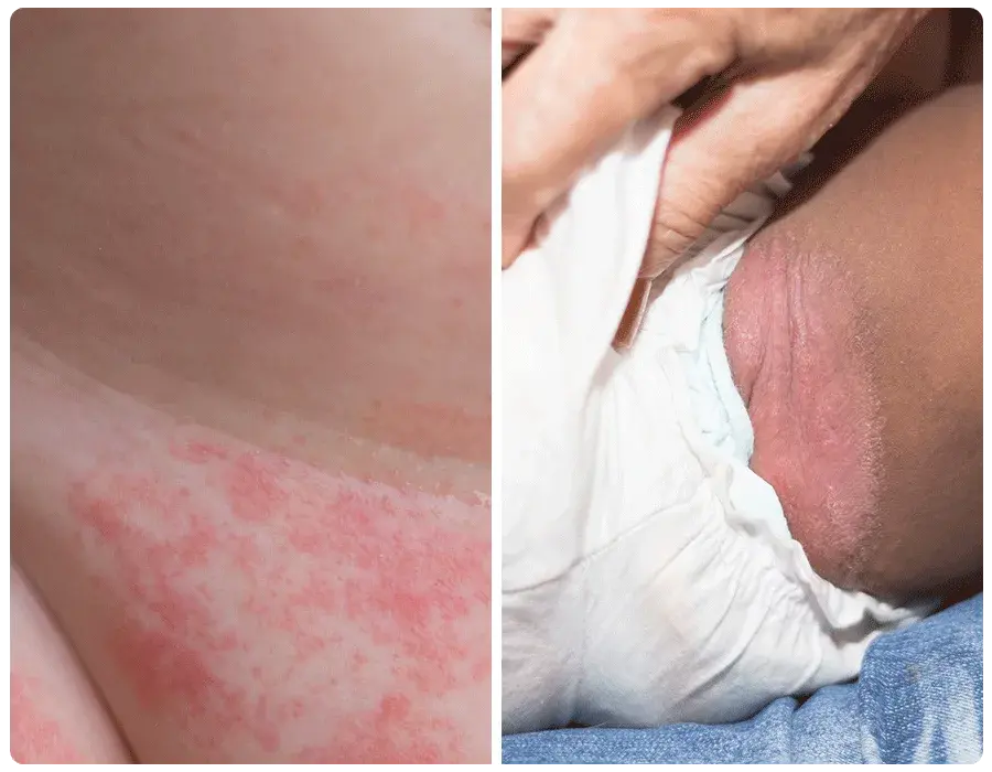 Why Diaper Rash Happens at Night