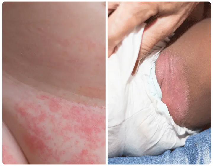 Why Diaper Rash Happens at Night
